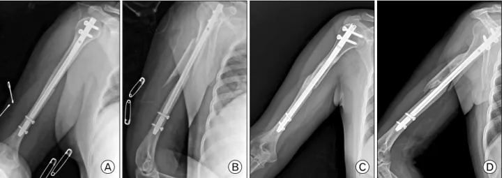 Table  2.  Postoperatively  radiologic  finding  of  mean  dis- dis-placement  and  length  of  fracture  fragments