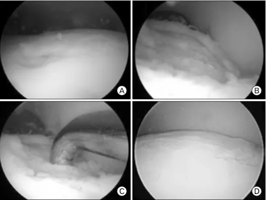 Fig.  2.  Arthroscopic  microfrac- microfrac-ture technique. (A) Arthroscopic  view  of  the  medial  talar  dome  lesion