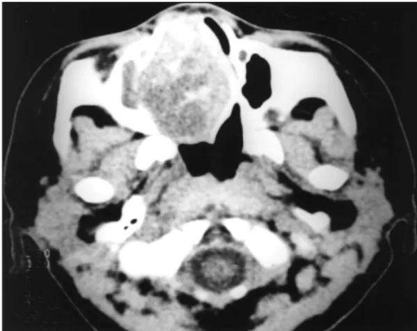 Fig. 2. MRI finding. A：Axial T2 weighted image. It shows well defined heterogeneous hyperintense nasal cavity mass containing low signal intensity foci