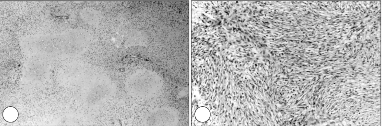 Fig. 3. Gross finding. The soft tissue mass was 2.5×3.5×