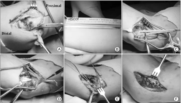 Fig. 3. Operative photographs of patient 1. (A) Complete tear of flexor muscle and marked proliferation of pinkish gran- gran-ulation  tissue