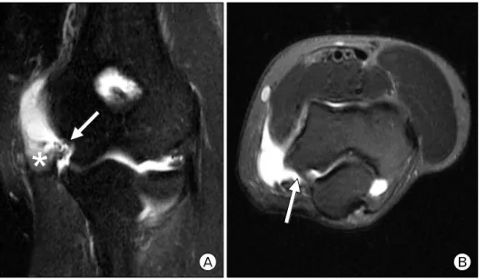 Fig. 5. Magnetic resonance ima- ima-ging  of  left  elbow  in  patient  2. 