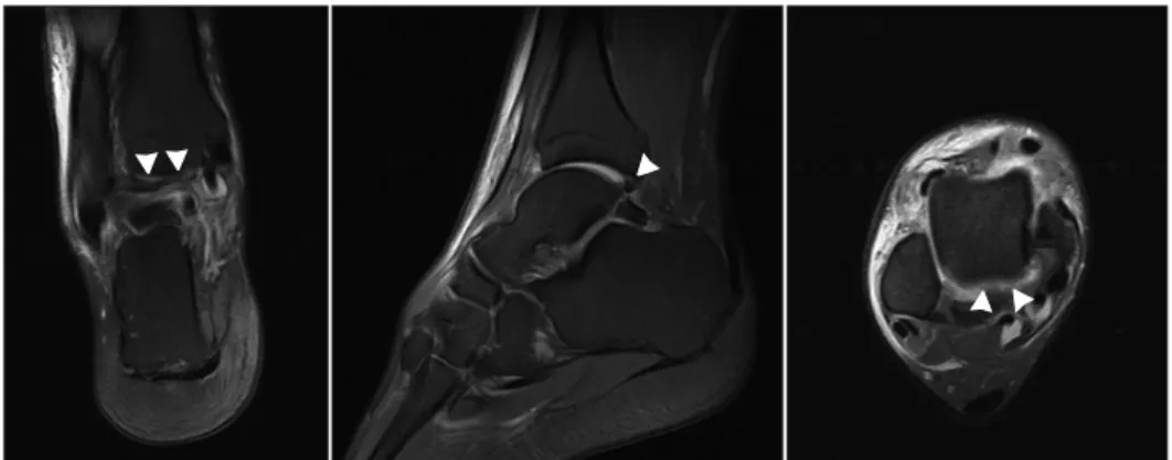 Fig. 3. Intraoperative ankle plain radiograph showing stable mortise  structure.내원하여  처음  시행한  단순  방사선  검사상  거골이  격자  구조 내에 안정적으로 위치하지 못했고,  거골의 후면부에 삼각 부골을 관찰할 수 있었다(Fig