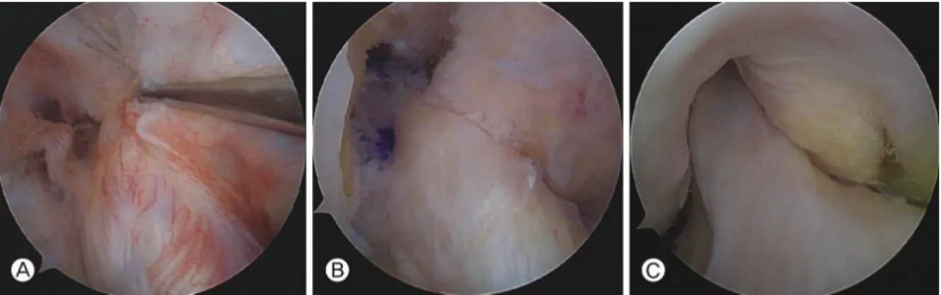 Fig.  1.  A:  On  arthroscopic  finding,  ACL  tibial  remnant  was  shown.