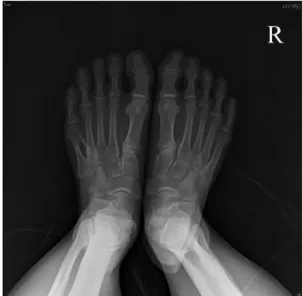 Fig. 2. Coronal computed tomography of left foot demon- demon-strating  fibrous  coalition  of  the  4th−5th  Intermetatarsal.