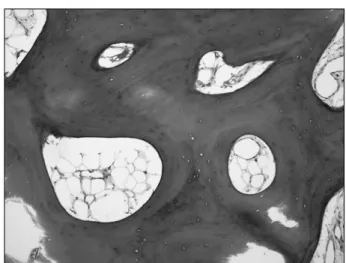 Fig.  5.  Bony  bridge,  low-power  histopathologic  image  showing  sections  of  mature  lamellar  bone  (H&amp;E,  ×20).