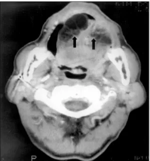 Fig. 1. Physical finding of bilateral multiple round ma- ma-sses along the lateral border of the tongue