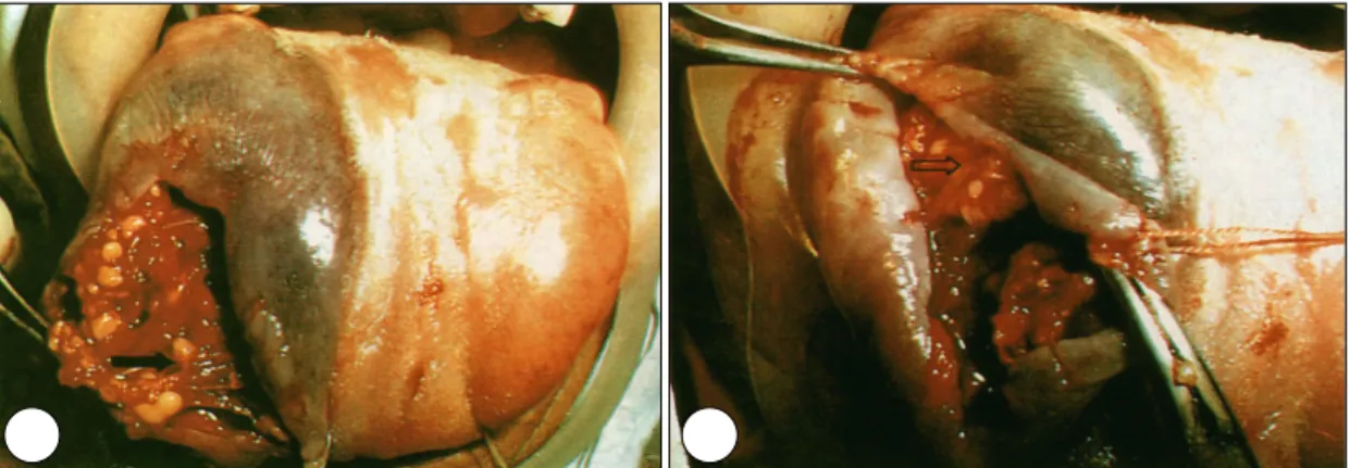 Fig. 4. Removed tumor masses after operation. 