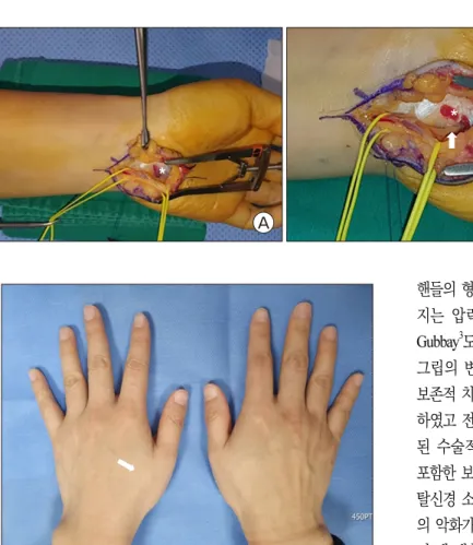 Fig. 3. (A) An intraoperative view  of  the  thickened  hypothenar  muscle  (asterisk)  compressing  the deep  motor branch of  ul-nar nerve