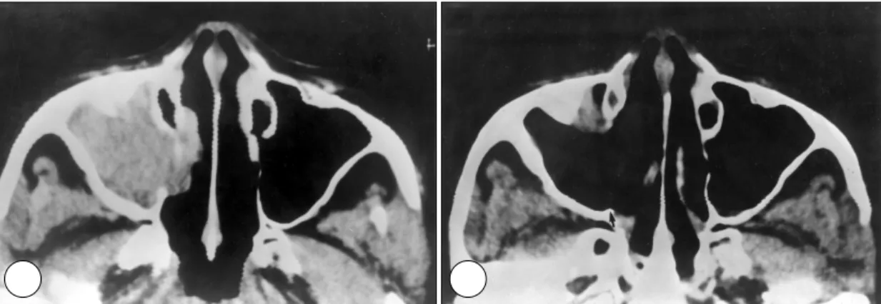 Fig. 3. Preoperative and postoperative computed tomography scans in the case that underwent modified middle meatal antrostomy