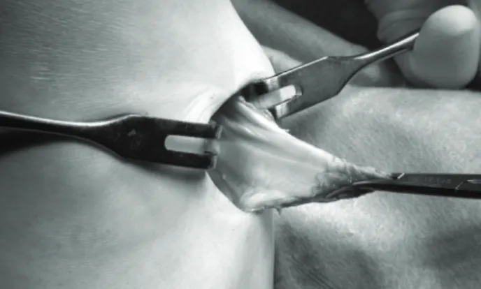 Fig.  1B.  sartorius  fascia  flap  was  made.