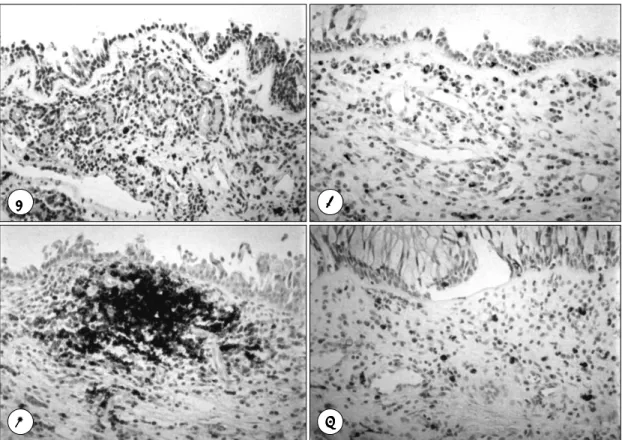 Fig. 2. Immunohistochemical staining of chronic inflammatory polyps. E：CD4 ＋  cells (×200)