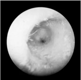 Fig. 2. Skull AP and law’s view show marked overgrowth and sclerosis of bone in the squamous, petrous part of left temporal bone with ground glass appearance