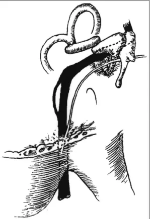 Fig. 2. Schematic view of the bifurcated facial nerve in  this case. 