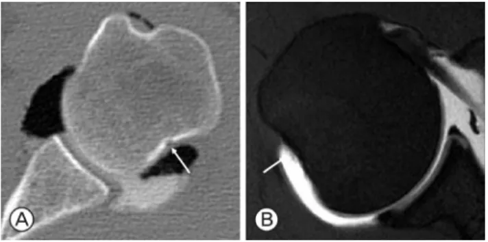 Fig. 2. Arthroscopic finding shows large Hill-Sachs lesion.