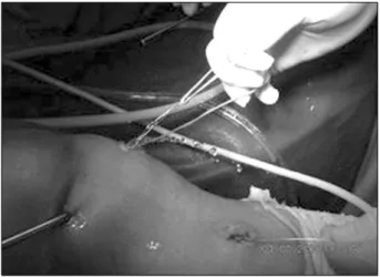 Fig. 4. All Ethibonds were brought out the tibial tunnel us- us-ing  advanced  wire  loop