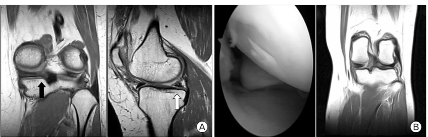 Fig. 7. (A) Postoperative MRI demonstrated intermediate signal density of healed meniscus tissue on foot print of posterior root of medial meniscus in coronal section (black arrow) and sagittal section (white arrow)
