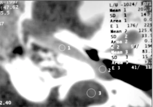 Fig. 3. The late venous phase view of contrast enhanced axial dynamic temporal bone CT shows well-defined soft tissue density (2) in middle ear cavity
