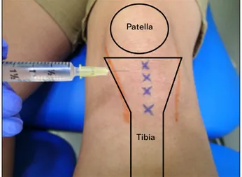 Fig. 3. Posterior photo of right lower leg showing injection points  for  management  of  Achilles  tendinopathy