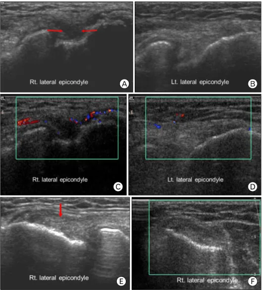 Fig.  5.  A  case  of  successful  treatment  with  prolotherapy  in  patient with lateral common  ex-tensor  tendon  tear  (A)