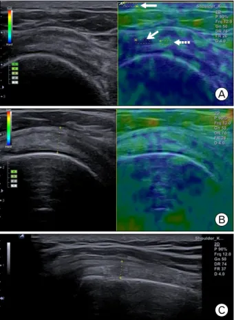 Fig.  2.  Measurement  of  strain  ratio  of  supraspinatus muscle. Reference box (rectangle box) was located at the subcutaneous  fat  layer  (closed  arrow)  and  the  same  size of  target  boxes  were  located  at  red  portion  of   supra-spinatus mus
