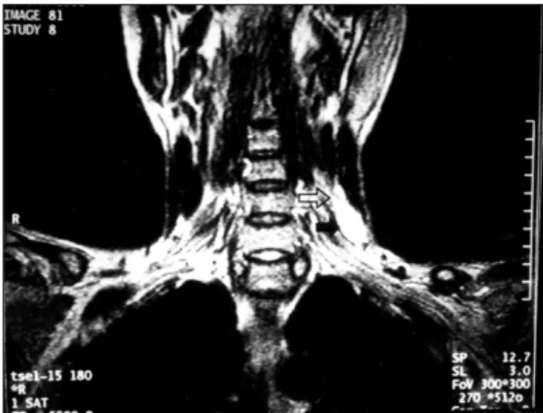 Fig. 1. Axial neck CT scan shows 2×2 cm sized cystic and solid mass in left posterior cervical area