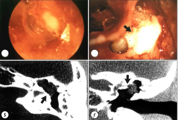 Fig. 4. The second case of unusual presentation：present lateral semicircular fistula. A：Myringoscopic finding：Whitish mass is seen at posterosuperior quadrant of the drum