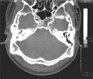 Fig. 2. Postcontrast axial (A) and coronal (B) T1-weighted images show non-enhancing low signal intensity thrombus and enhancement of the vessel wall in the right transverse sinus, sigmoid sinus and internal jugular vein