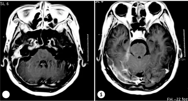 Fig. 4. A right internal cerebral artery angiogram, venous  phase, AP view, demonstrates nonfilling of the right  tra-nsverse sinus, sigmoid sinus, and internal jugular vein