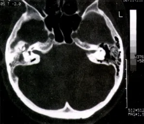 Fig. 5. Axial CT scan of the temporal bone shows the soft tissue density in the mastoid antrum and middle ear cavity