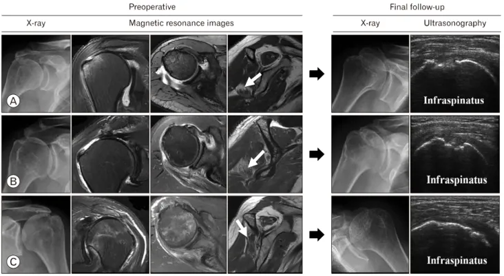Table  5.  Structural  characteristics  of  three  cases  of  postoperative  retear  after  complete  repair Age  (yr)  Sex SSP 