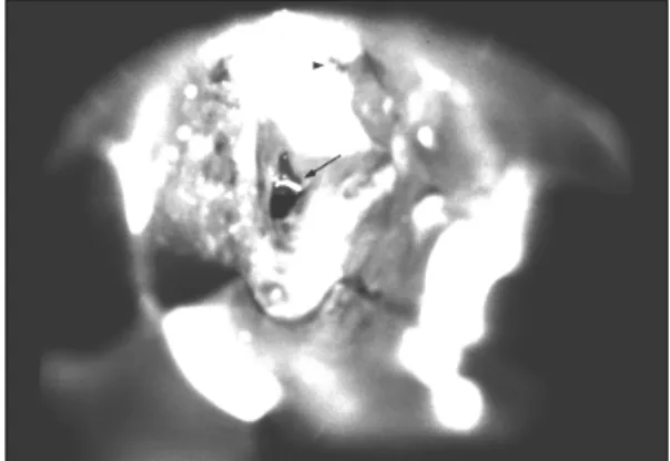 Fig. 4. The foreign body (arrow) revealed after submu- submu-cosal dissection at the posterior hypopharyngeal wall.