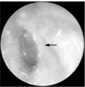 Fig. 4. Postoperative computed tomography of temp- temp-oral bone. Posteror canal wall is well maintained and  ca-nal is patent (arrow：reconstructed portion by cartilage).