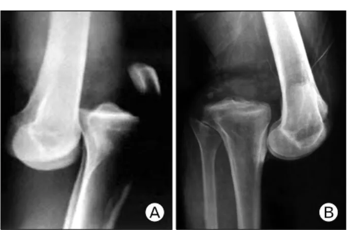 Fig.  1.  (A)  Anterior  dislocation.  (B)  Posterior  dislocation.