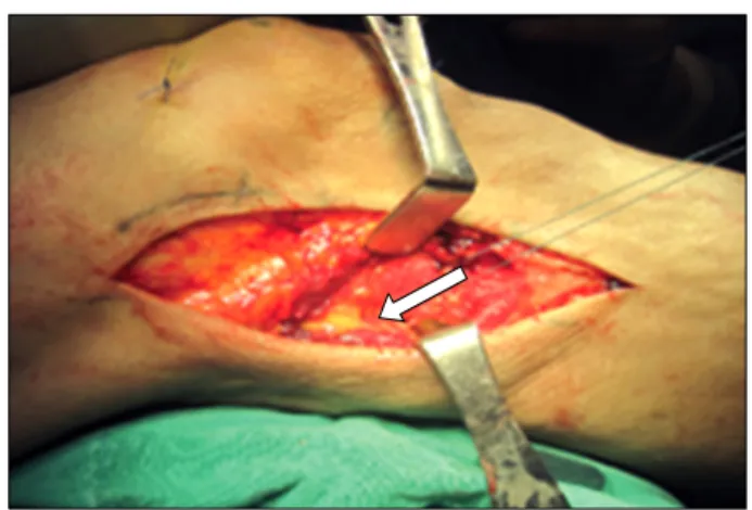 Fig. 2. (A) The arteriogram showed complete popliteal ar- ar-tery  occlusion.  (B)  Bypass  graft  using  contra-lateral   sa-phenous vein and four-compartment fasciotomy was  per-formed  immediately