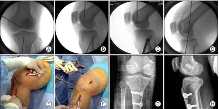 Fig.  5.  Arthroscopic  assisted  simultaneously  anterior  cruciate  ligament  (ACL)  and  posterior  cruciate  ligament  (PCL)  re- re-construction in the knee dislocation