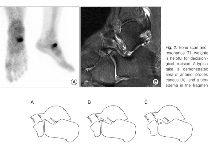 Fig. 2. Bone scan and magnetic resonance  T1  weighted  image  is helpful for decision of a  sur-gical excision