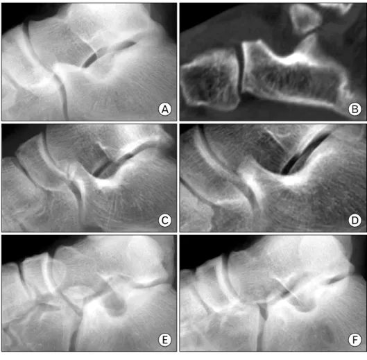 Fig.  4.  This  radiographs  show  the  Degan’s  classification.  (A)  and (B) is type I, (C) and (D) is type  II,  (E)  and  (F)  is  type  III