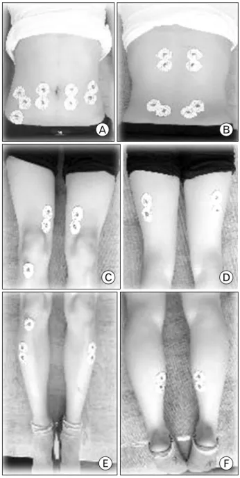 Fig.  1.  Location  of  attached  surface  electromyogram (EMG)  electrodes.  (A)  Rectus  abdominis,  External   obli-ques