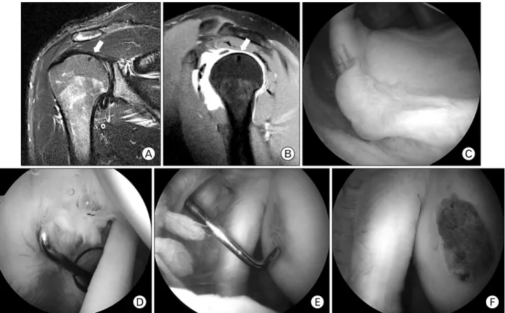 Fig. 1. (A, B) Coronal and sagittal magnetic resonance images show no significant osteochondral lesion of humeral head, but suspected lesion with low signal intensity as subchondral lesion (white arrow)