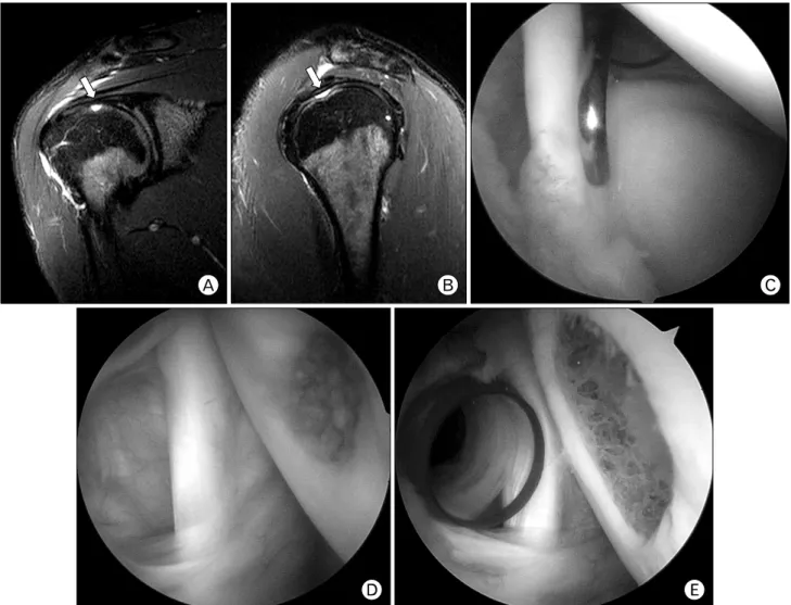 Fig. 2. (A, B) Magnetic resonance images show a focal chondral defect on the superior aspect of humeral head with high signal  intensity  on  T2-weighted  images  (white  arrow)