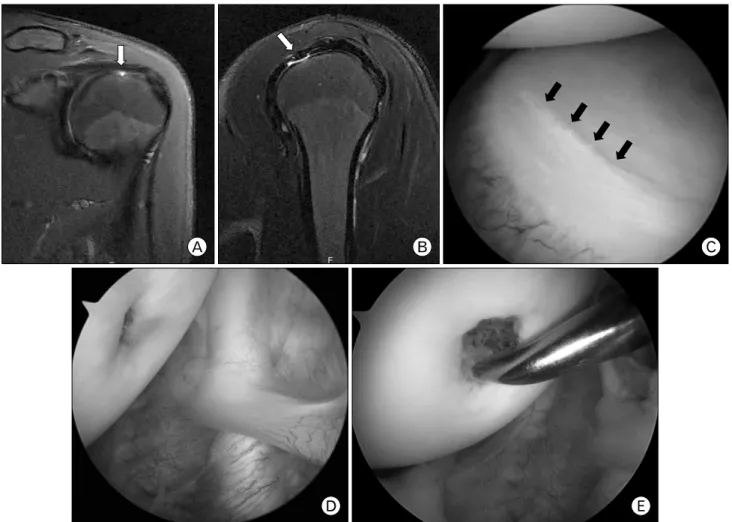 Fig. 3. (A, B) T2-weighted magnetic resonance images show high signal intensity lesion suspected as a chondral lesion (white  arrow)