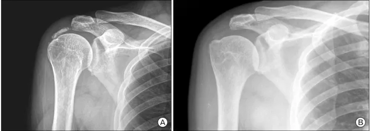 Fig.  2.  (A)  Initial  plain  X-ray  of  calcific  tendinitis  patient.  (B)  After  6  months,  follow-up  X-ray  of  extracorporeal  shock ave  therapy  therapy  patient  for  calcific  tendinitis.