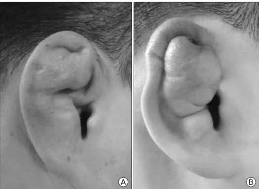 Fig. 1. (A) Microtia is morpholo- morpholo-gically  smaller  than  normal  sized ear. (B) Prominent ear has  pro-truded  soft  tissue  or  mass  like  bump.