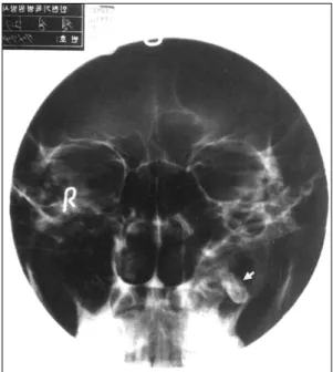 Fig. 3. Endoscopic view of the left maxillary sinus shows  ectopic tooth. 