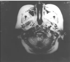 Fig. 1. Coronal MR (T1WI with GD-PTPA) shows lateral wall bulging with low signal intensity foci by thrombus (arrow) of left cavernous sinus, and mucoperiosteal thickening of both sphenoid sinus