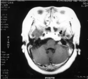 Fig. 4. Coronal CT shows air-fluid lateral wall bulging of right cavernous sinus (arrow)