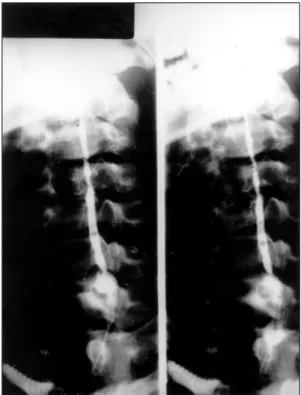 Fig. 4. MRI T1W1 finding shows small fine high signal in- in-tensity in subcutaneous layer of neck, right side thyroid cartilage level, left thyroid gland respectively, without communication with deep site