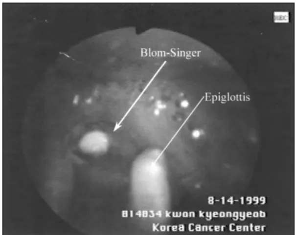 Fig. 3. Postoperative endoscopic finding. 