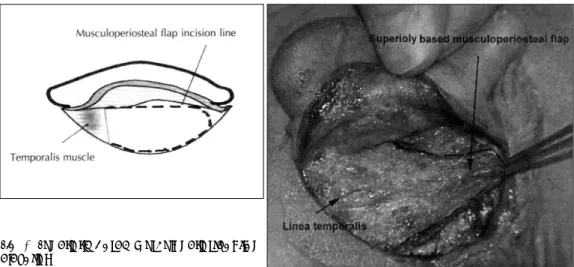 Fig. 2. Posterior auricular skin elevation. 
